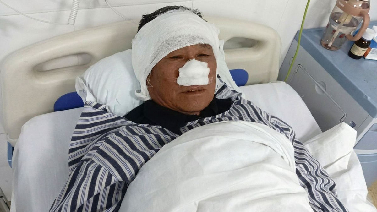 Chinese Village Mediator Hailed as National Hero After Losing Nose to Save Woman from Attacker