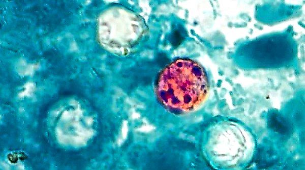 The Detection Puzzle: Why Cyclospora Outbreaks Are So Hard to Track Down