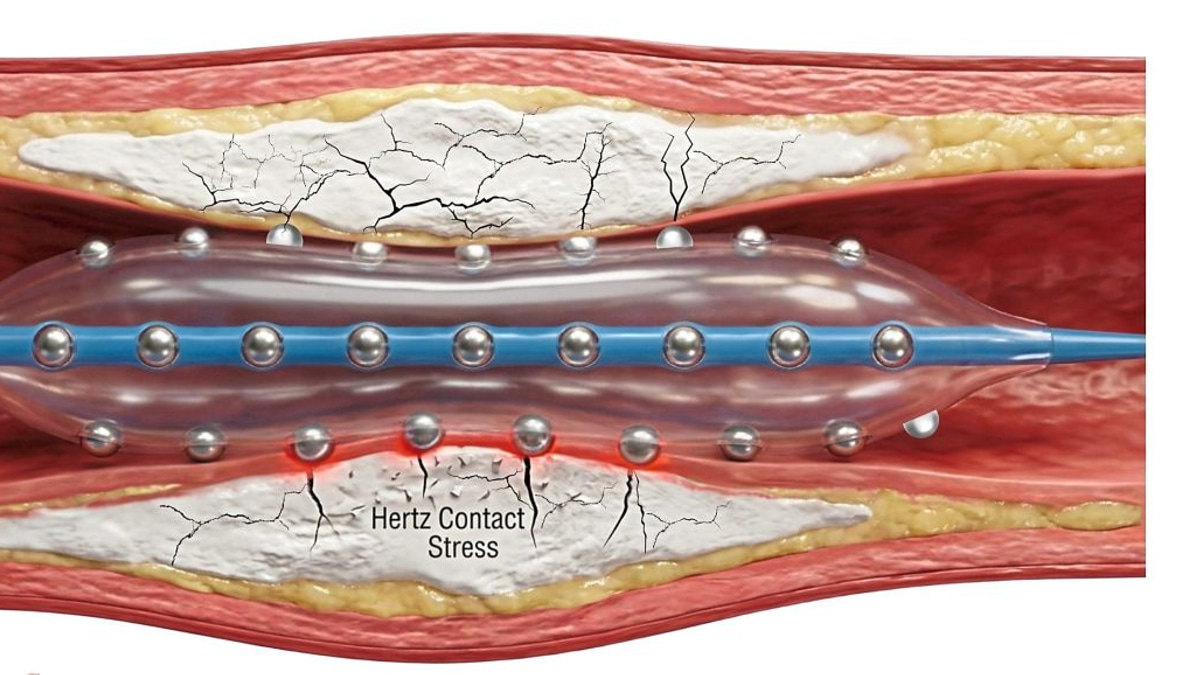 Malaysian cardiologists pioneer advanced plaque-busting technology for calcified heart arteries