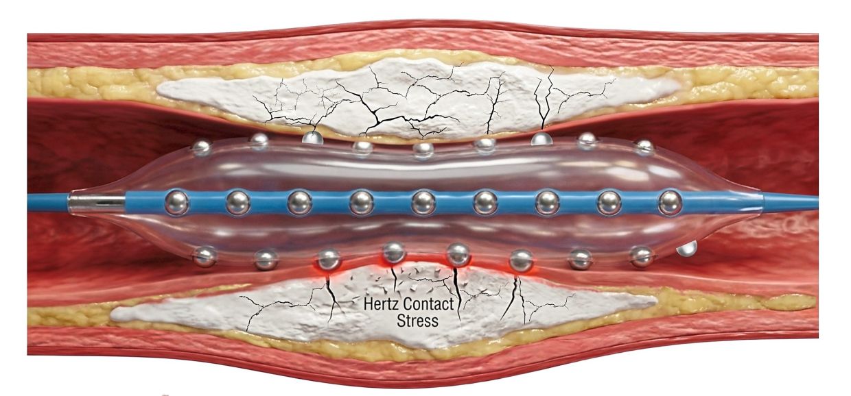 Malaysian cardiologists pioneer advanced plaque-busting technology for calcified heart arteries